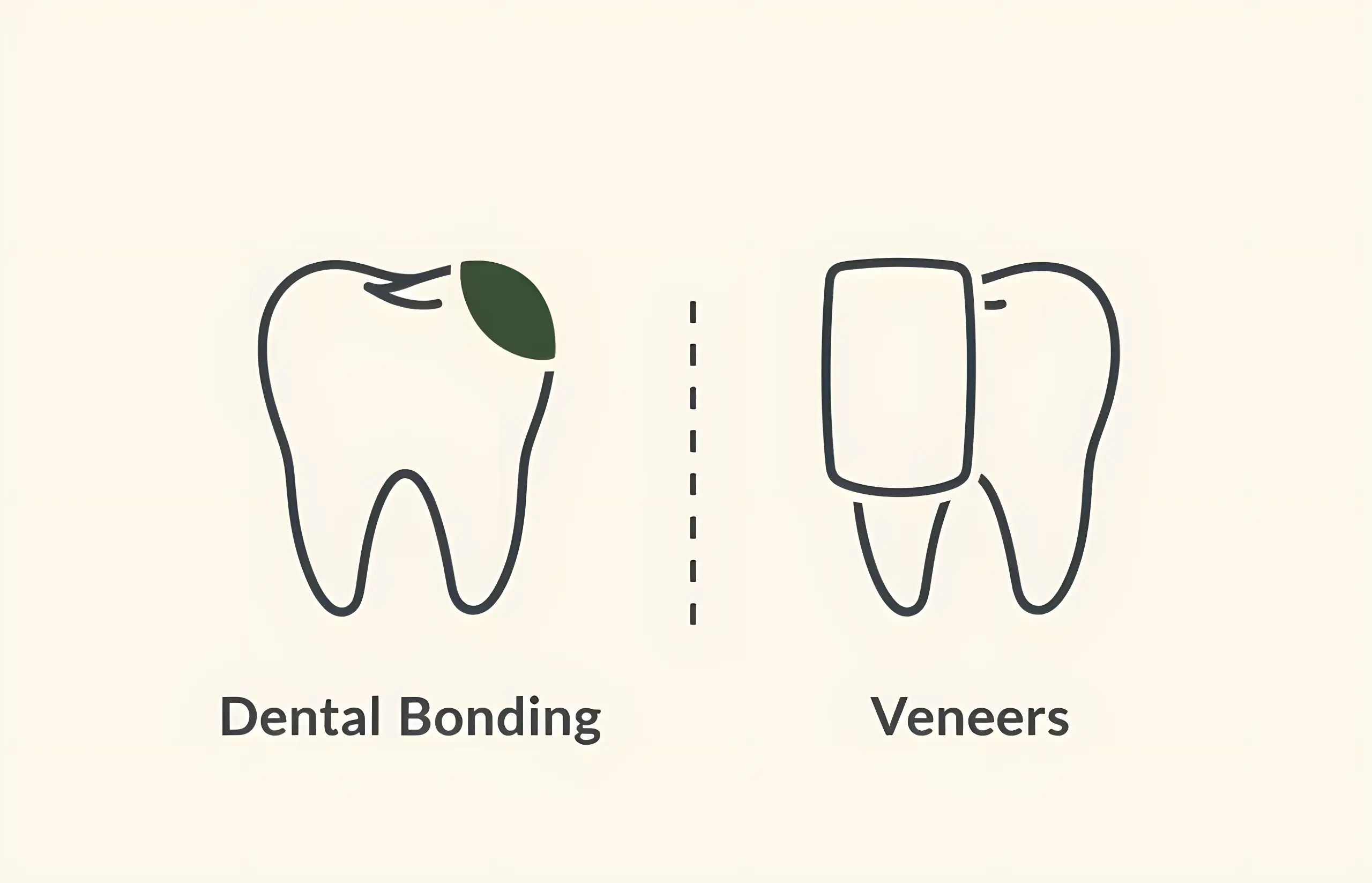 Dental Bonding v Veneers